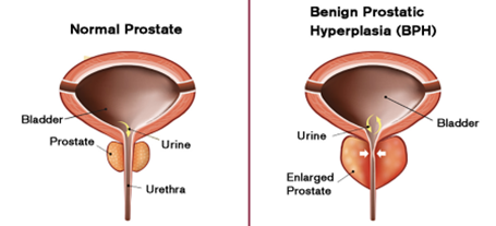 UroLift para BPH, Centro Médico Regional de Wellington