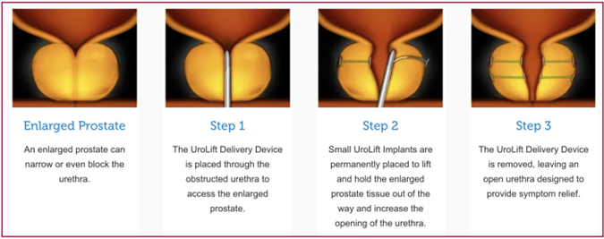 UroLift for BPH, Wellington Regional Medical Center