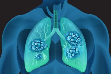 Cuidado del cáncer de pulmón