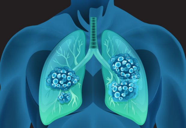 Cuidado del cáncer de pulmón